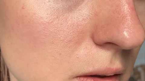 a girl facing the problem of open pores
