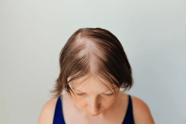 Androgenic alopecia