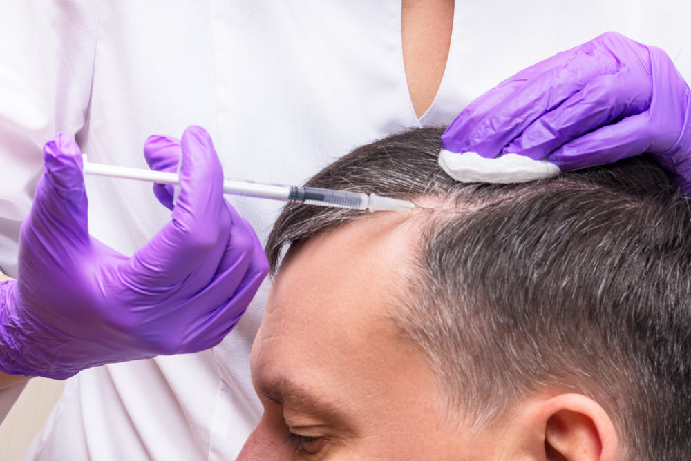 man doing PRP alopecia 
TREATMENT