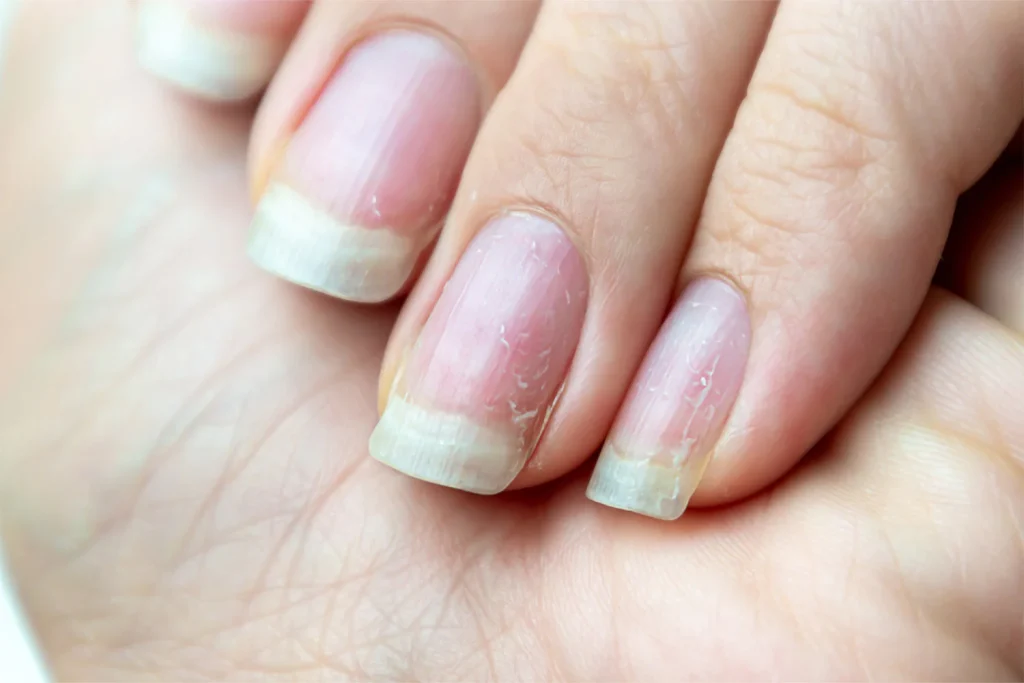 girl with brittle nails
